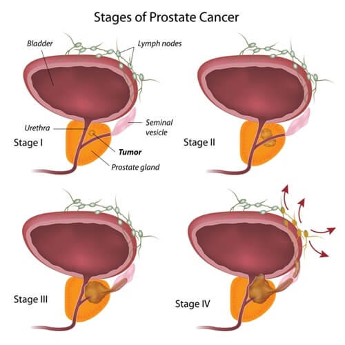 4 Prostate Cancer Stages
